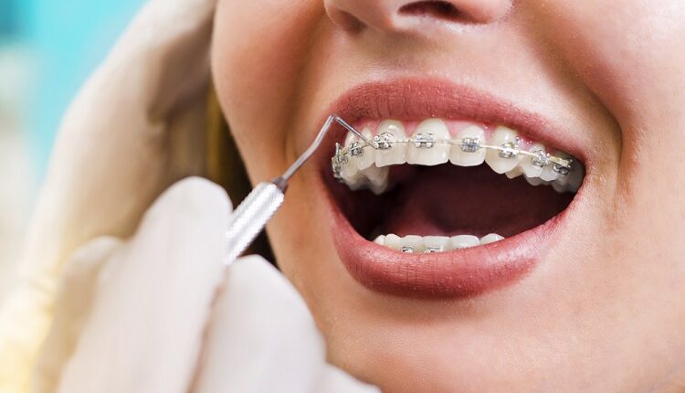 Orthodontic Treatment